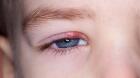 El orzuelo: qué es y cómo prevenirlo